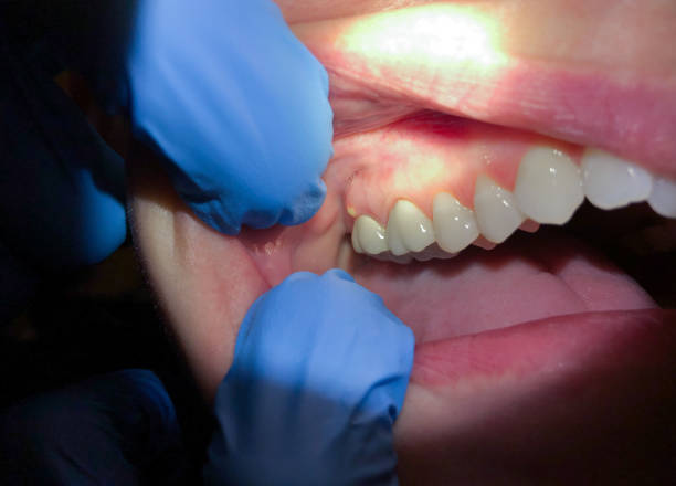 Best Emergency Gum Treatment in Woodcreek, TX