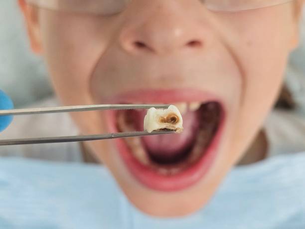 Best Emergency Treatment for Dental Infections or Abscesses in Woodcreek, TX